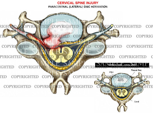 Cervical disc herniation - paracentral - axial view