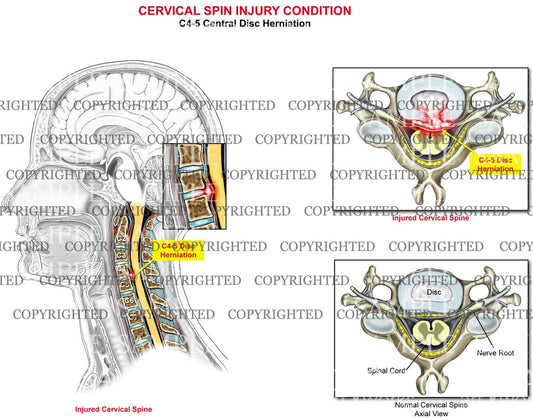 C4-5 disc herniation - central