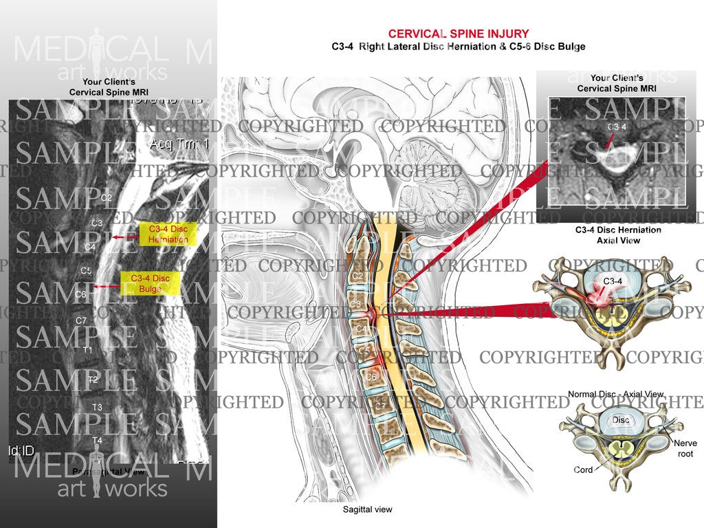 C3-4 disc herniation and C5-6 bulge