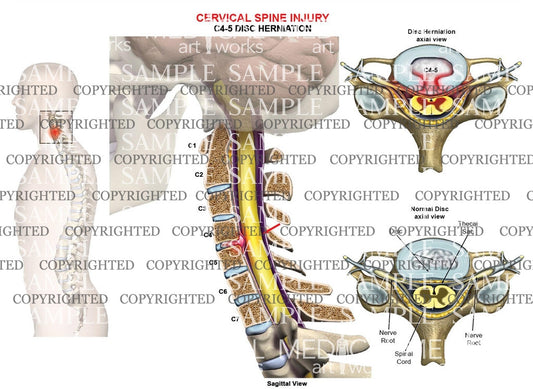 C4-5 disc herniation - central