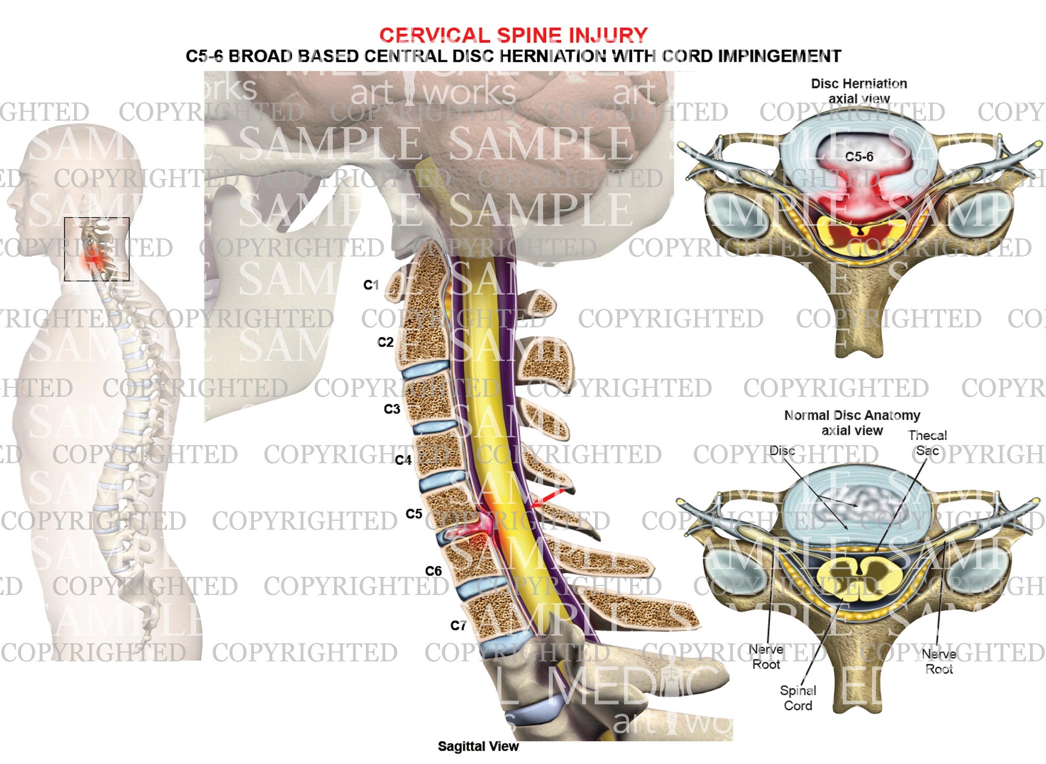 C5 6 Pattern C5-6 disc herniation - broad-based – Medical Art Works