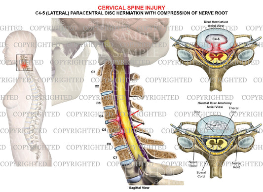 1 level - C4-5 paracentral disc herniation