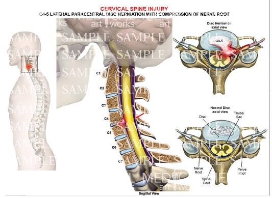 C4-5 disc herniation - paracentral