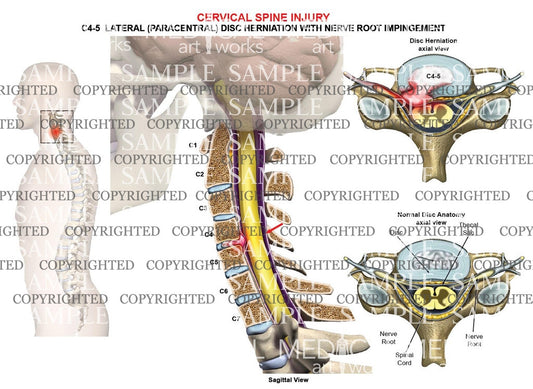 C4-5 disc herniation - nerve root impingement