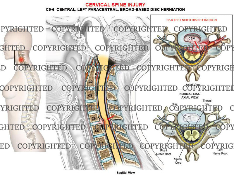 C5-6 left paracentral disc herniation, extrusion