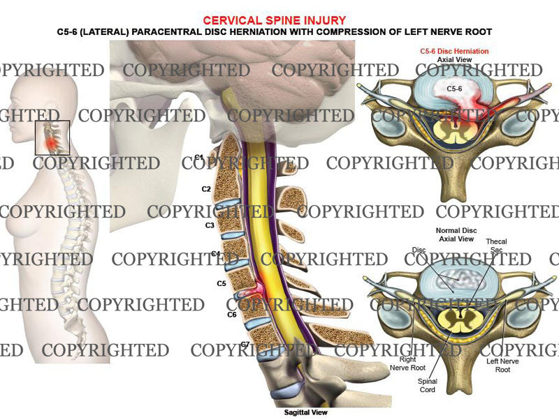 C5-6 left lateral, paracentral disc herniation, compression
