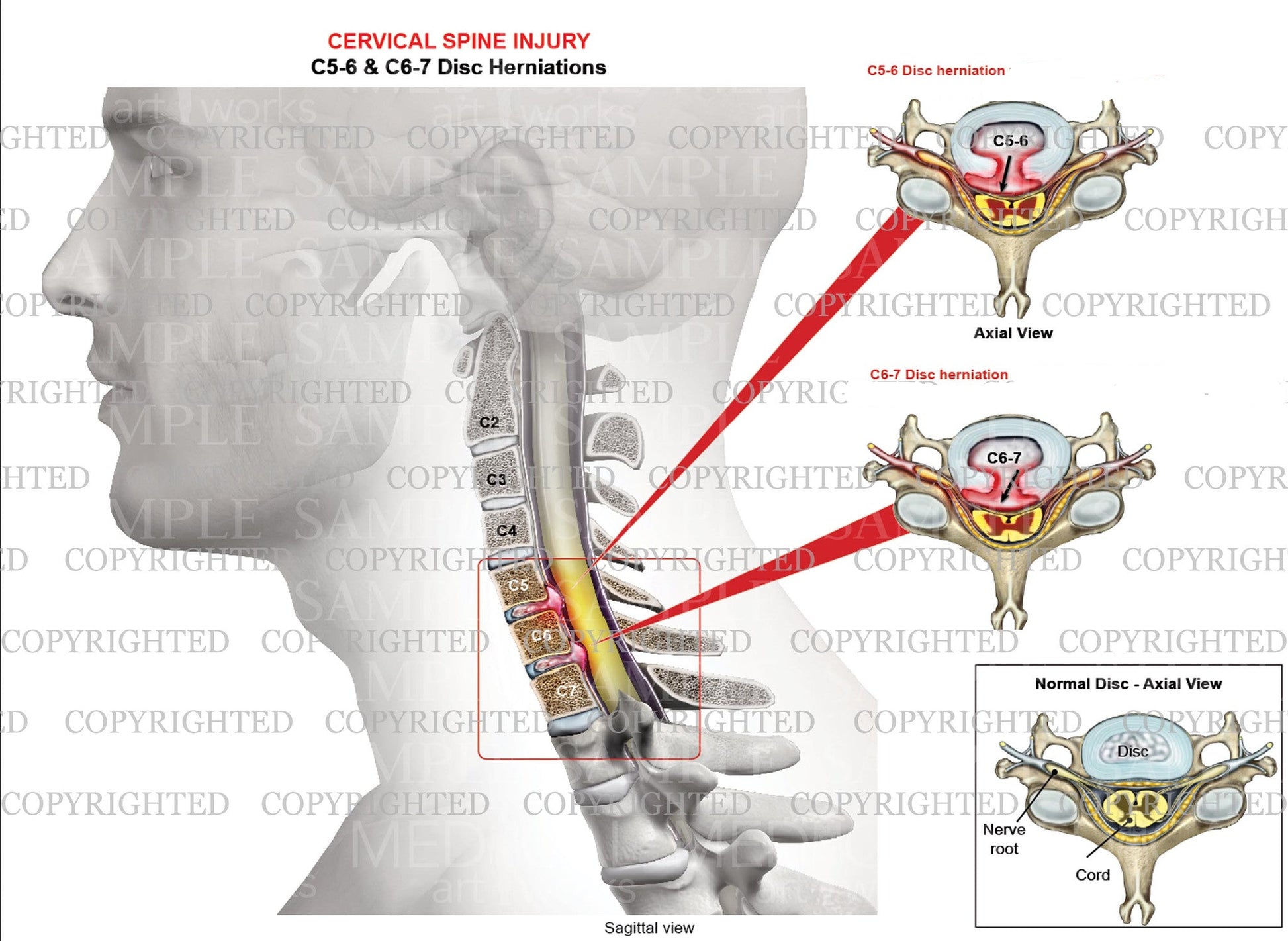 C5-6  & C6-7 Cervical disc herniation - Bilateral foraminal narrowing