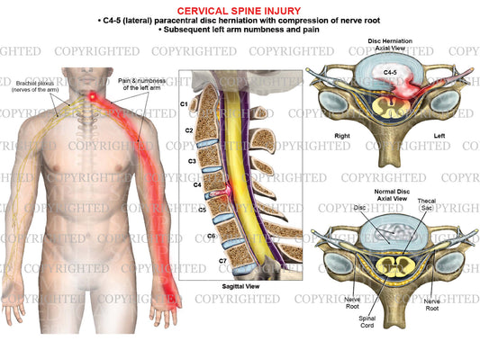 C4-5 disc herniation - paracentral - left arm nerve pain numbness