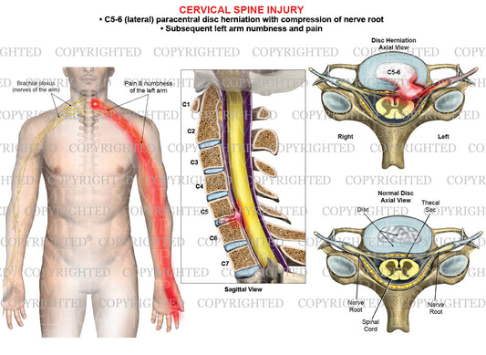 C5-6 disc herniation - paracentral - left arm nerve pain numbness