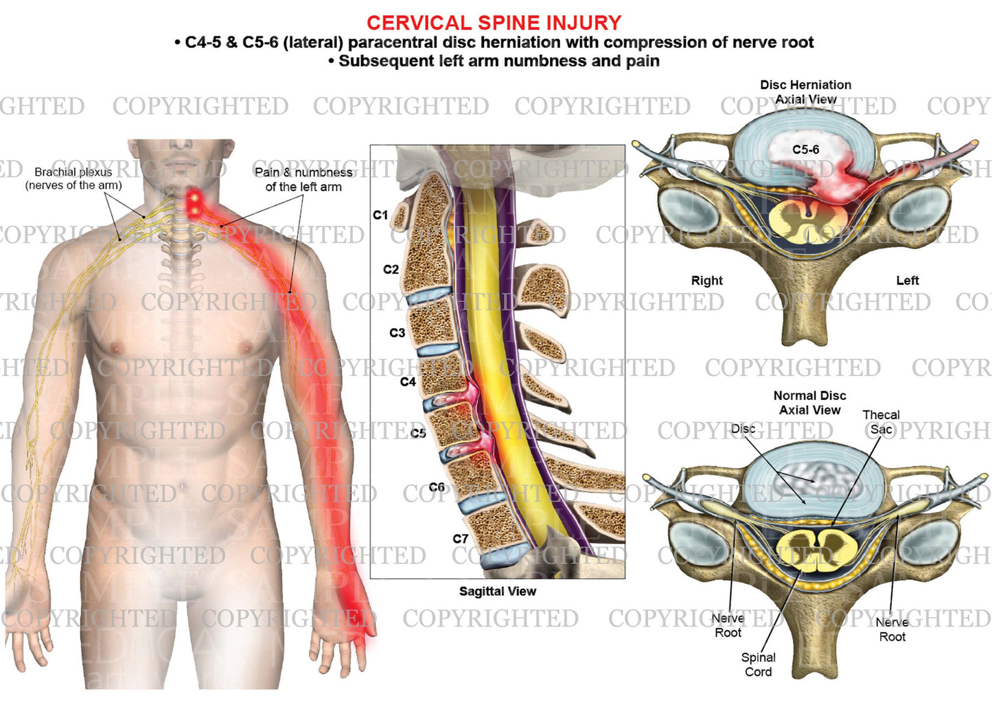 2 lavel - C4-5 and C5-6 disc herniation - paracentral - left arm nerve pain numbness
