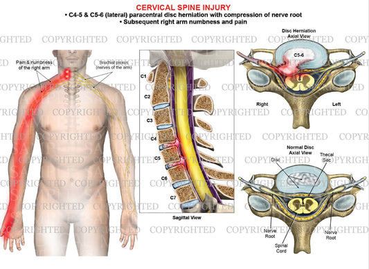 C4-5 and C5-6 paracentral disc herniationl with right arm nerve pain numbness