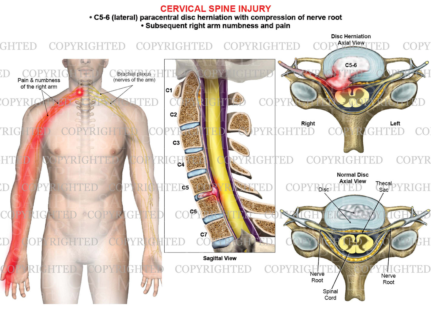 C5-6 disc herniation - paracentral - right arm nerve pain numbness