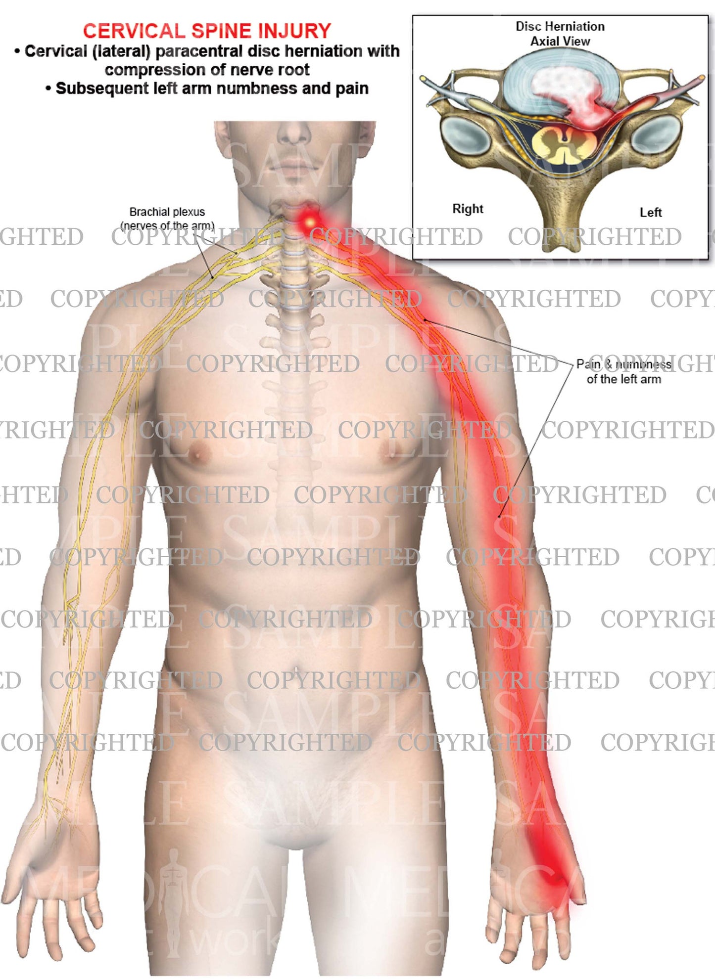 Cervical disc herniation - paracentral - left arm nerve pain numbness