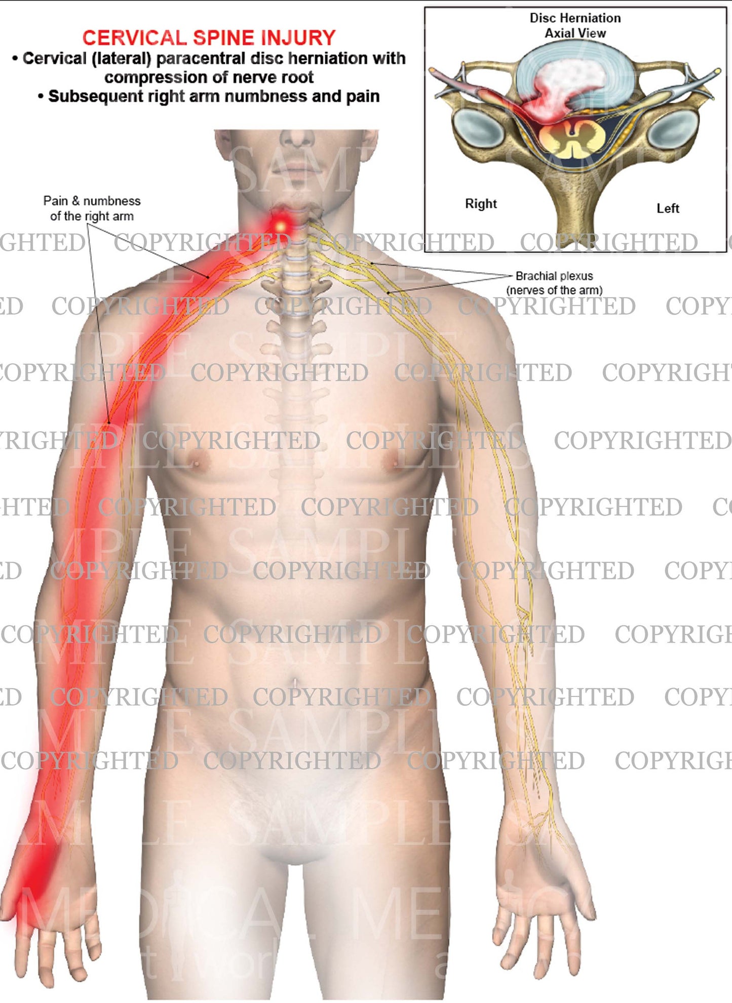 Cervical disc herniation - paracentral - right arm nerve pain numbness