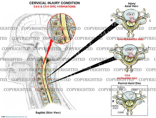 2 level - C4-5 and C5-6 disc herniations