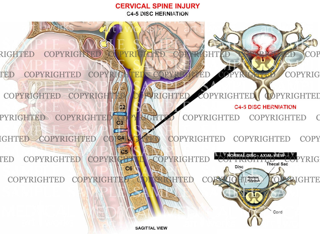 C4-5 central disc herniation