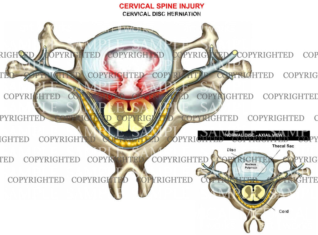 Cervical herniation- central - axial view