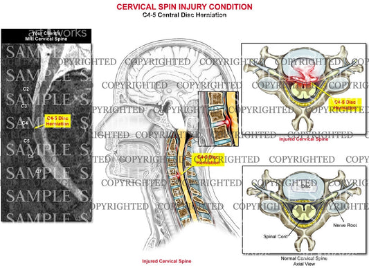 cervical disc herniation c4-5