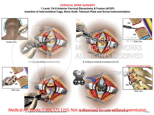 C4-5 Anterior cervical discectomy and fusion ACDF -Illustration African American