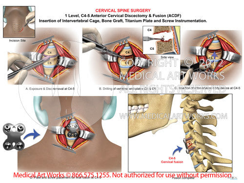 Anterior cervical spine discectomy and fusion