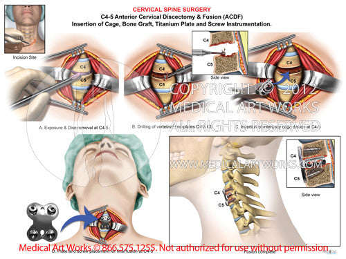 1 level - C4-5 Anterior cervical discectomy and fusion ACDF