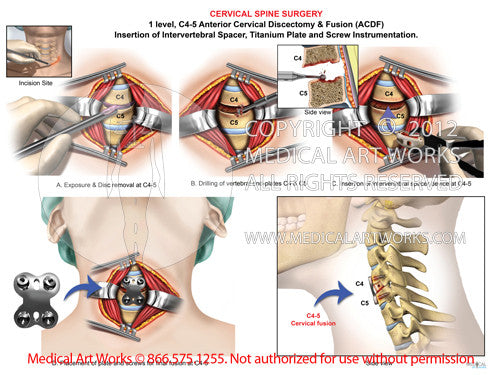 C4-5 Anterior cervical discectomy and fusion ACDF