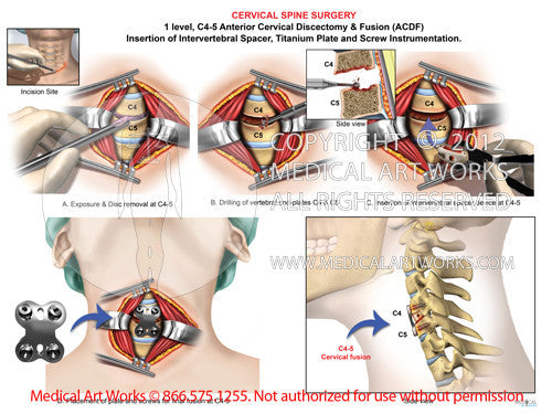 1 level - C4-5 Anterior cervical discectomy and fusion ACDF PEEK