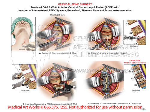 2 Level - C4-5 & C5-6 Anterior cervical discectomy and fusion. ACDF - Female - Left incision