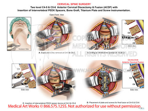 anterior cervical discectomy and fusion -  female