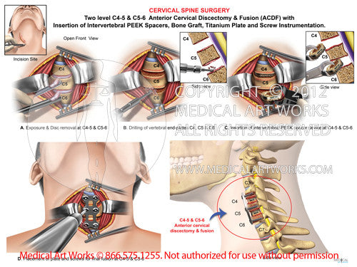 2 Level - C4-5 & C5-6 Anterior cervical discectomy and fusion. ACDF - Male