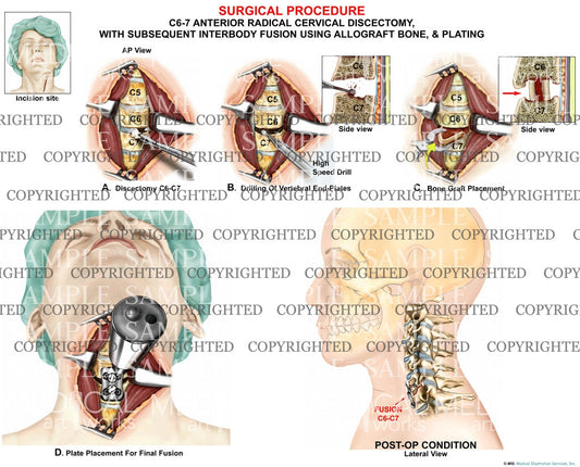 Medical Illustration - 1 level - C6-7 discectomy and fusion