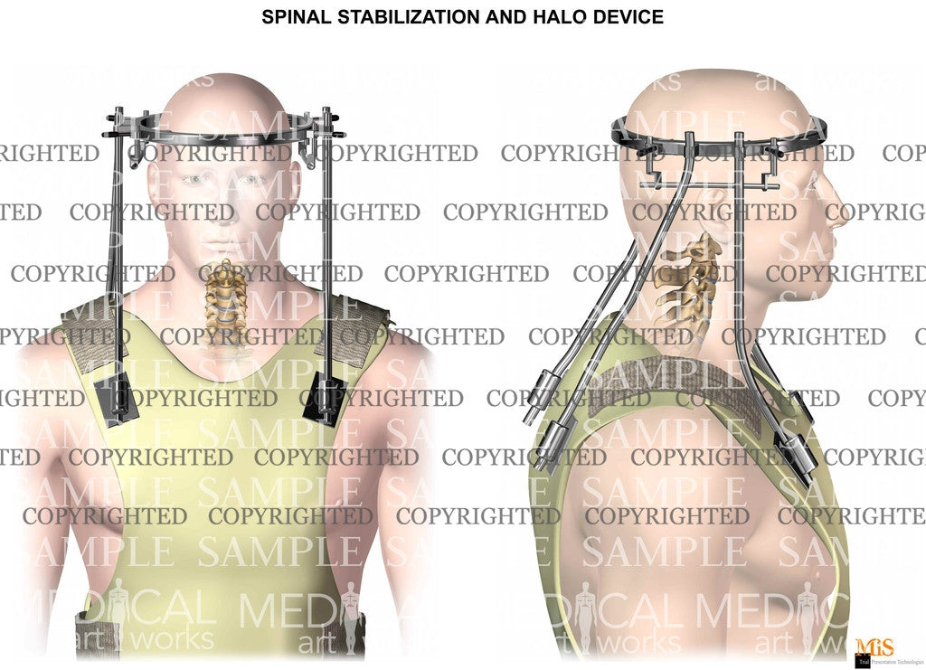 Halo device - spinal stabilization