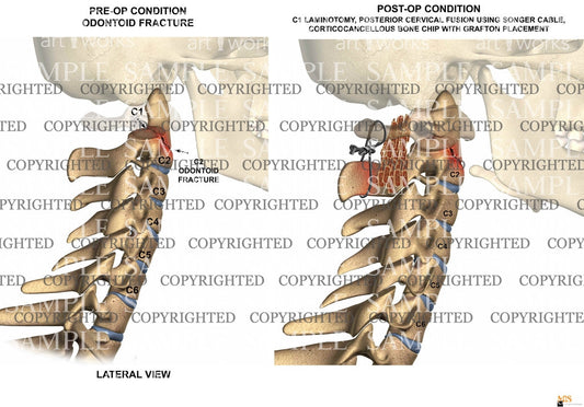 1 level - C1-C2 posterior cervical fusion - lateral