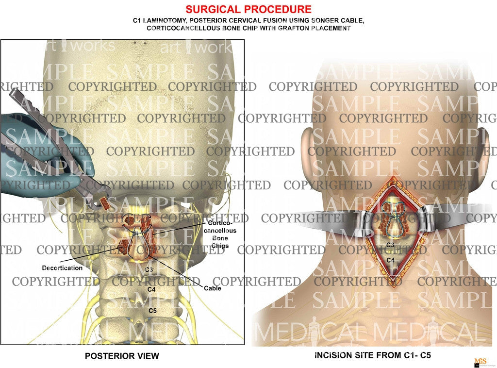 1 level posterior cervical spine fusion