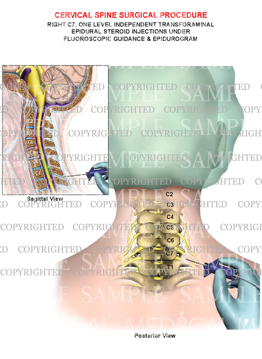 Cervical spine one level epidural steroid injections