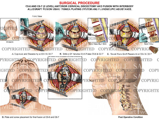 C5-6 & C6-7 discectomy + fusion - 2 level