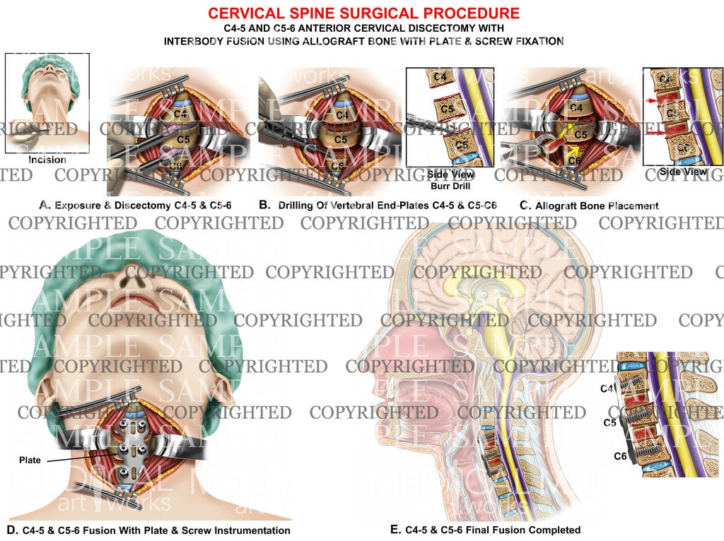 C4-5 and C5-6 cervical discectomy and fusion