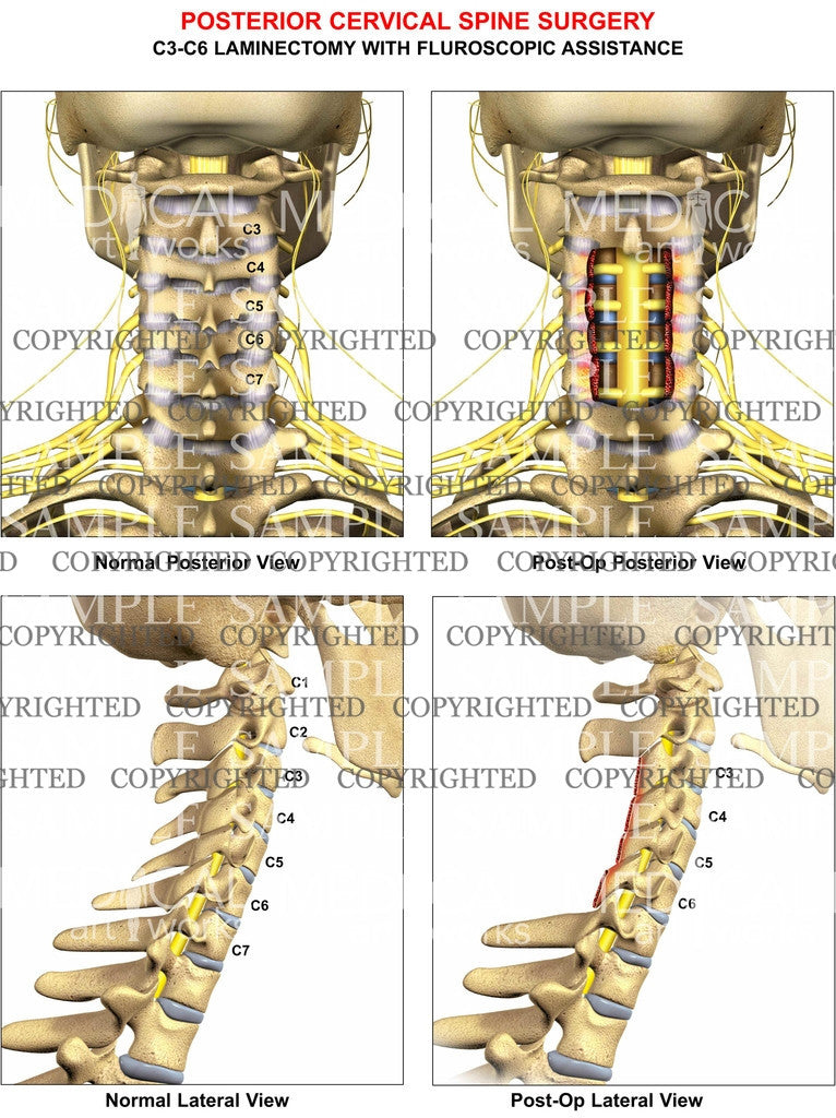 3 level - C3-C6 cervical spine posterior laminectomy
