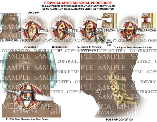1 level - C3-4 anterior cervical discectomy and fusion