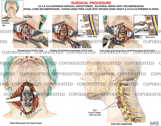 C4-5 and C5-6 cervical discectomy and fusion using peek cage