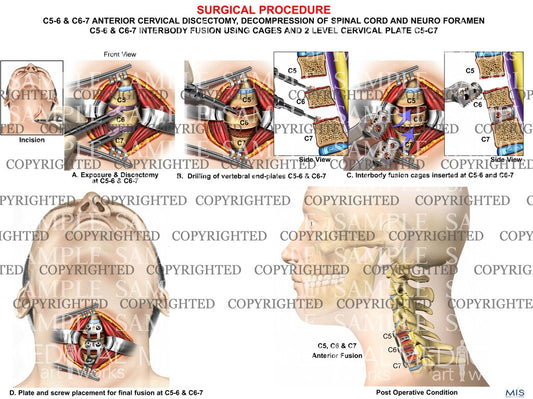 C5-6 & C6-7  discectomy + fusion - 2 level ACD