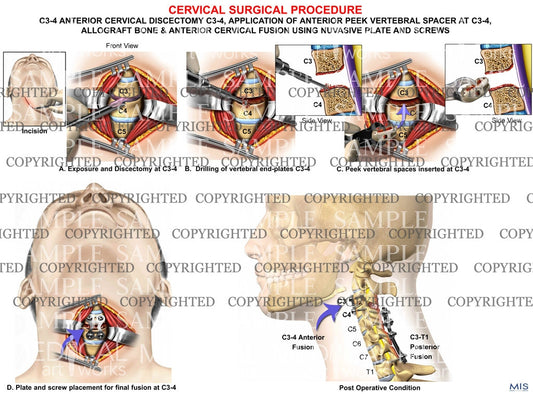 1 level - C3-4 Anterior discectomy and interbody fusion ACDF