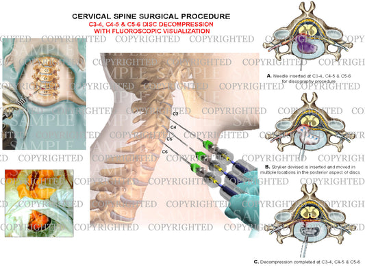 3 level - C3-4, C4-5 and C5-6 cervical spien decompression surgery with fluoroscopy