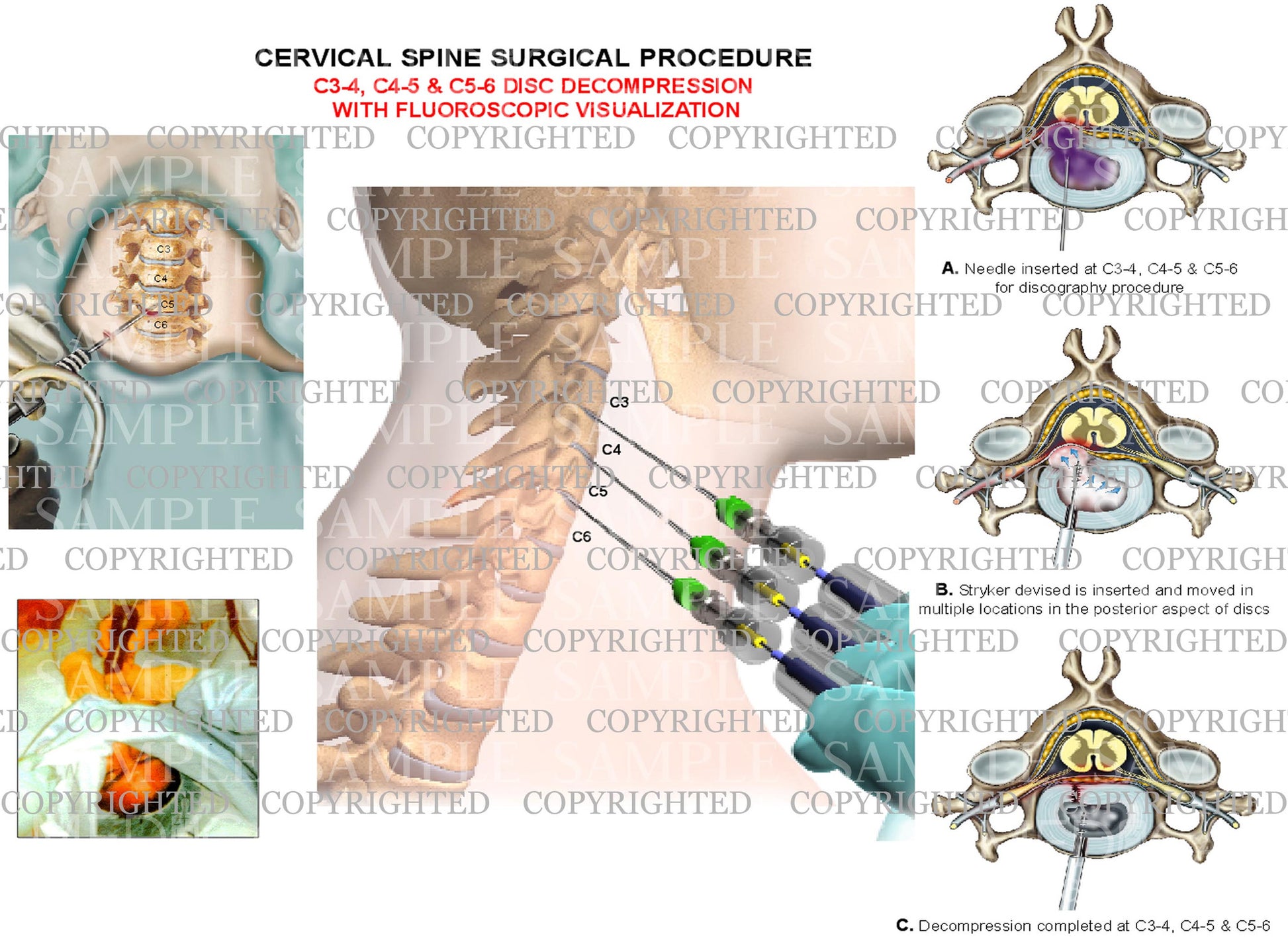 3 level - C3-4, C4-5 and C5-6 cervical spien decompression surgery with fluoroscopy