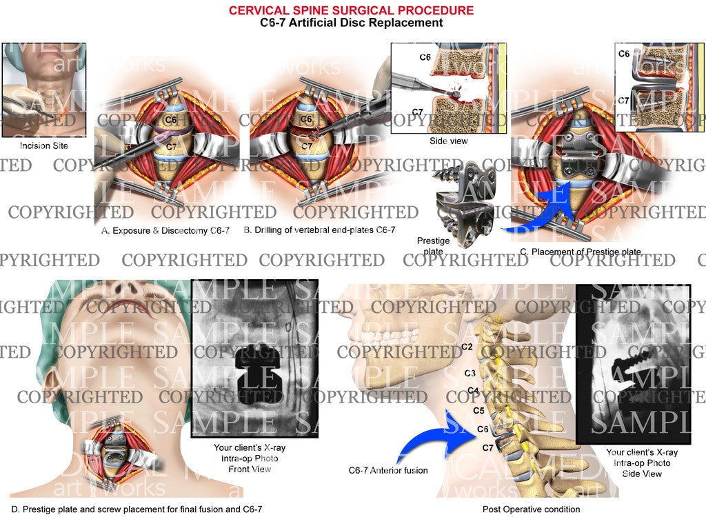 C6-7 cervical artificial disc replacement