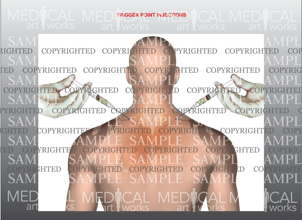Trigger Point Injection Drawing Trigger point injection – Medical Art Works