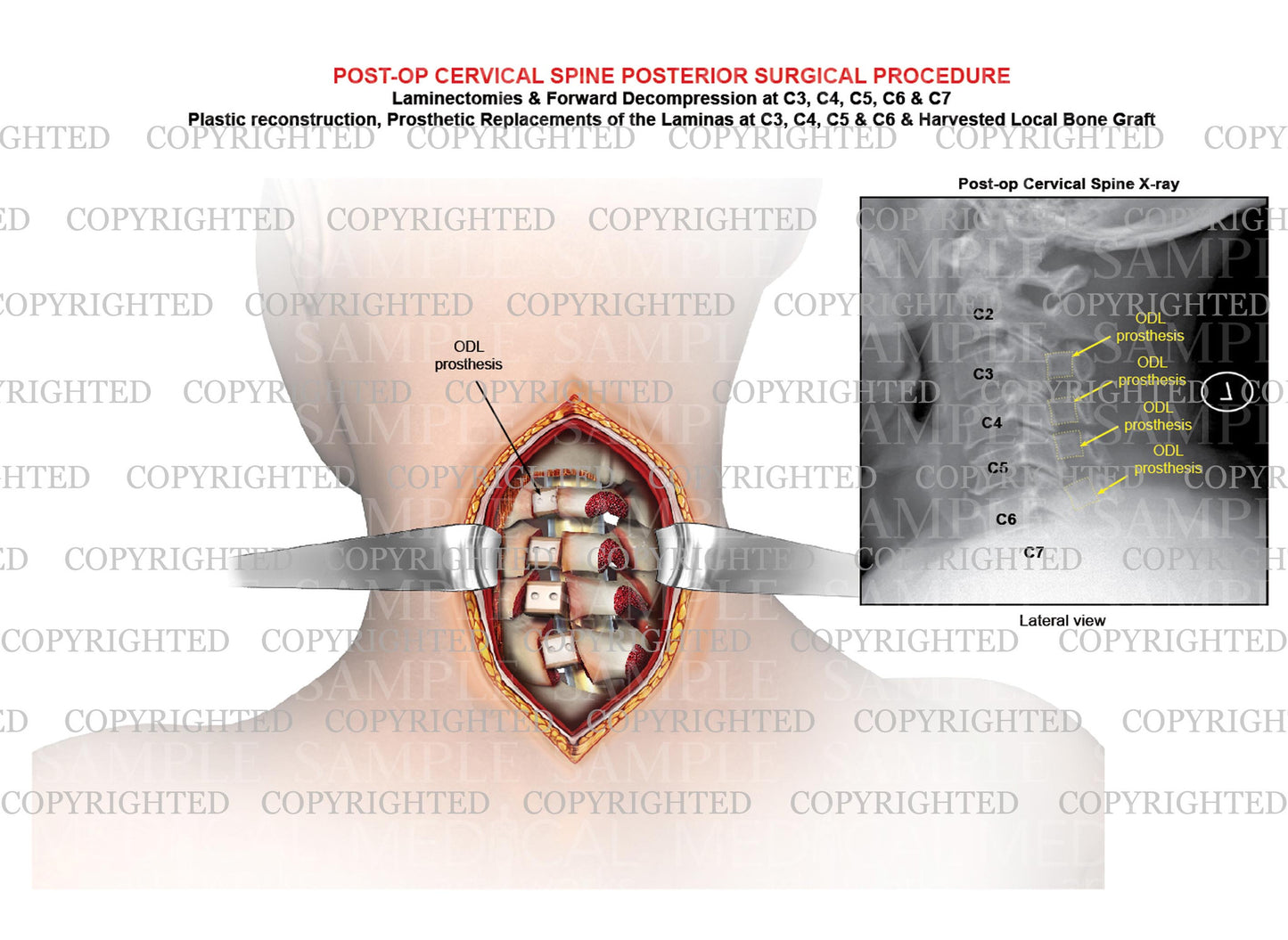 Post operative condition of posterior cervical surgery - Open door laminoplasty