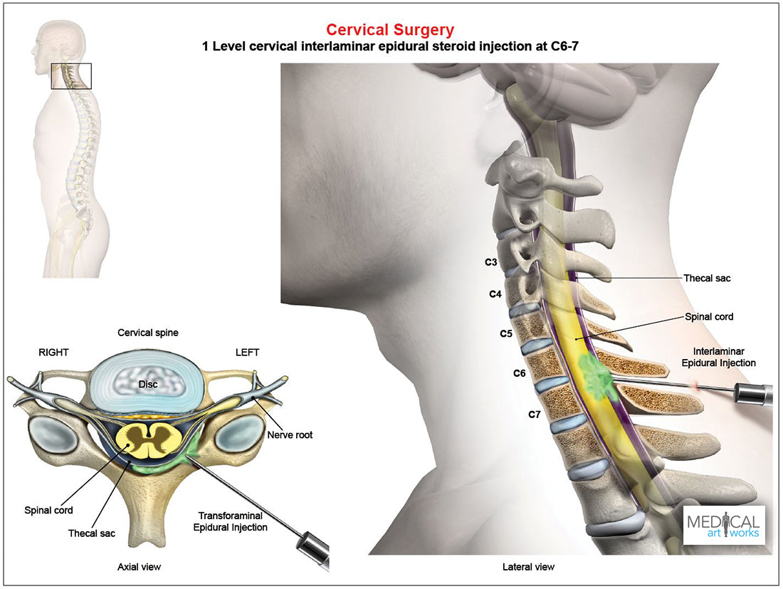 C6-7 Cervical Interlaminar Epidural Steroid Injection - Male