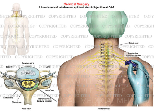 Medical Illustration 1 Level - C6-7 Posterior Cervical Interlaminar Epidural Steroid Injection - Male