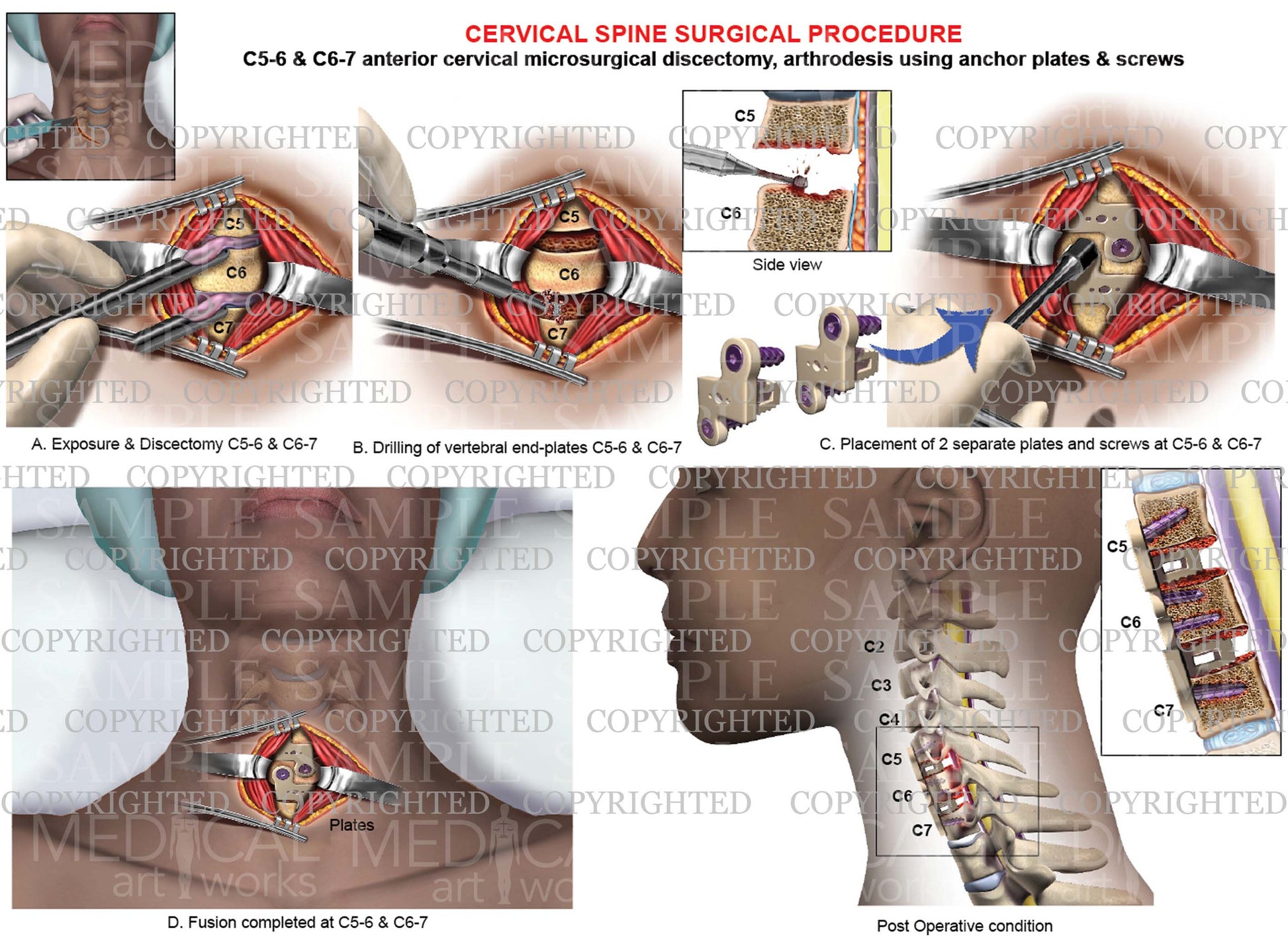 Anterior cervical discectomy and fusion  - plate & screws - female